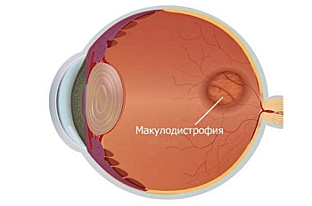 Макулодистрофи́я и лечение